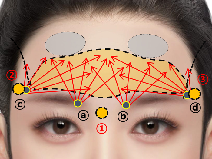 Design for Forehead Injection